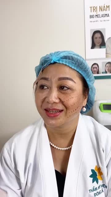 Kết quả căng chỉ 1/2 gương mặt Bio Lift tại Đông Á