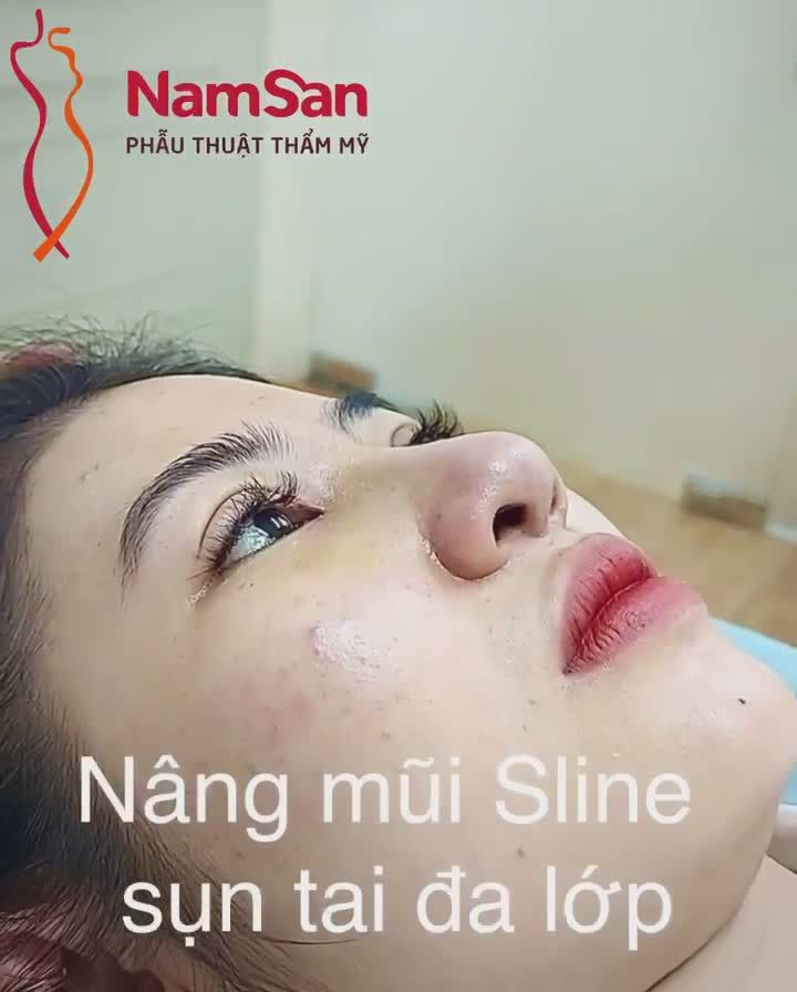 Kết quả nâng mũi Sline sụn tai lớp