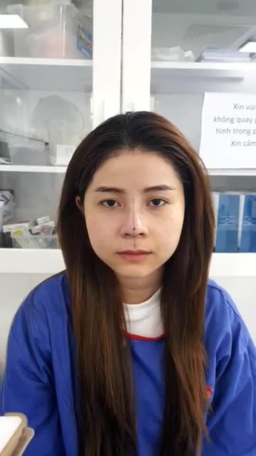 Muốn mũi sau nâng cao tự nhiên, không lộ thẩm mỹ CHỌN CÔNG NGHỆ GÌ?
