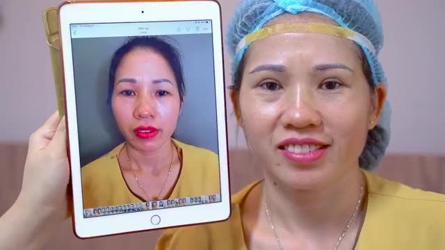 Nâng cung mày có khắc phục hoàn toàn tình trạng sụp mí hay không và có sưng đau nhiều không?