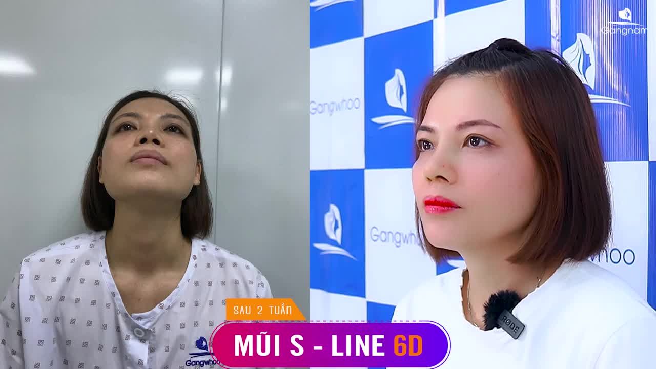 NÂNG MŨI BAO LÂU THÌ ĐƯỢC NẰM NGHIÊNG?