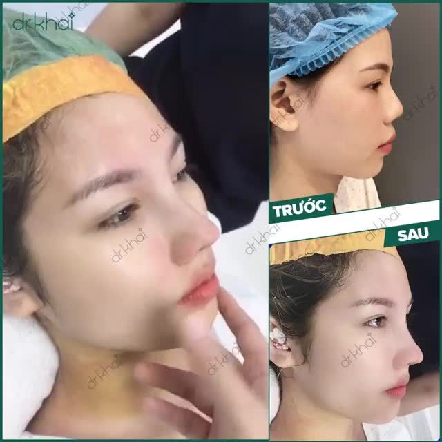 Nâng mũi cấu trúc kiến tạo chiếc mũi hoàn hảo