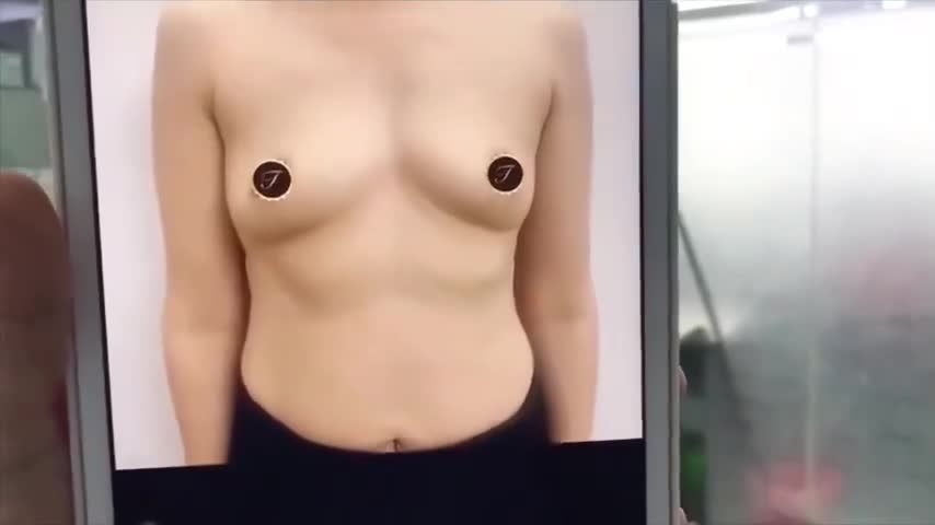 Phẫu thuật nâng V1 Bác sỹ Dương Văn Tươi Thẩm mỹ Saigon Young