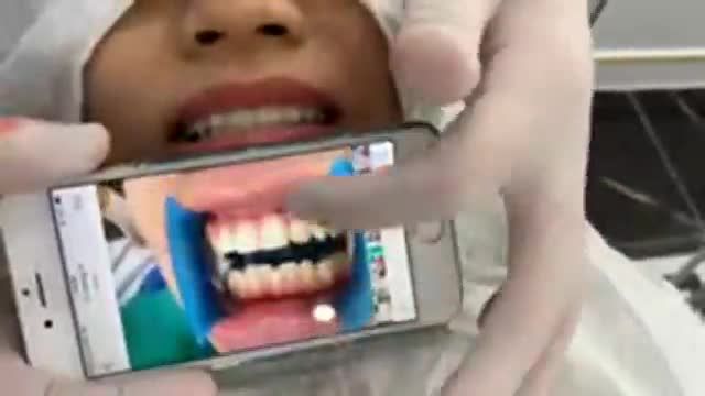 Test case thẩm mỹ toàn hàm 20 răng sứ Nacera cao cấp.