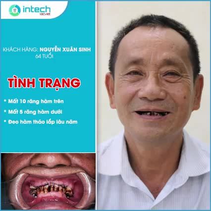 TRỒNG RĂNG IMPLANT ĐỂ ĂN NGON HƠN, CƯỜI ĐẸP HƠN