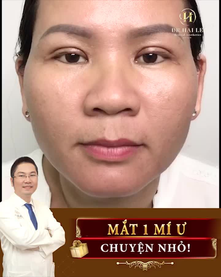 Mắt 1 mí, mí lót, sụp mí ..."biến hình" sau 30 phút với Cắt mí thẩm mỹ
