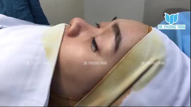NÂNG MŨI SỤN SƯỜN TOÀN PHẦN  TỶ LỆ VIÊM NHIỄM BẰNG 0