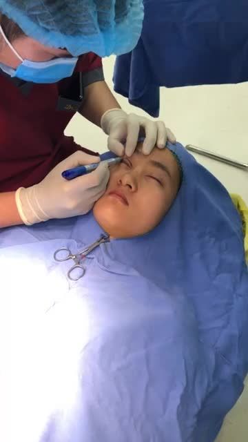 Giải pháp nào cho đôi mắt Sụp mí bẩm sinh nặng thành mắt hai mí to tròn?