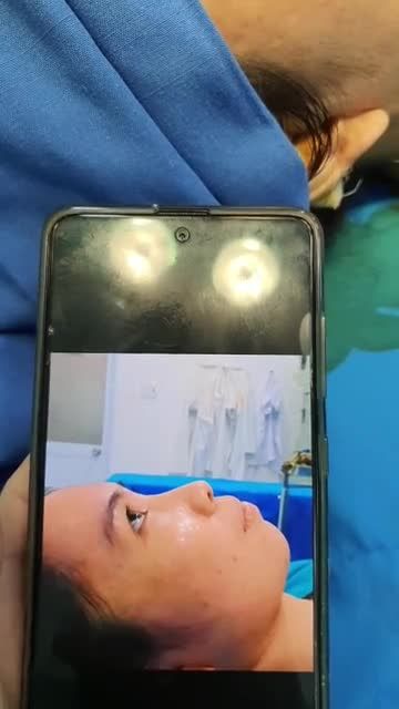 KHÁCH HÀNG NÂNG MŨI BS KỲ Y DƯỢC  NÂNG MŨI BÁN CẤU TRÚC ĐA LỚP