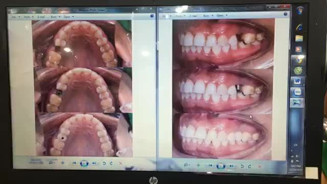 Lắp răng implant phục hình răng 25 bị mất cho cô khách hàng tại Nha Khoa Thùy Anh.