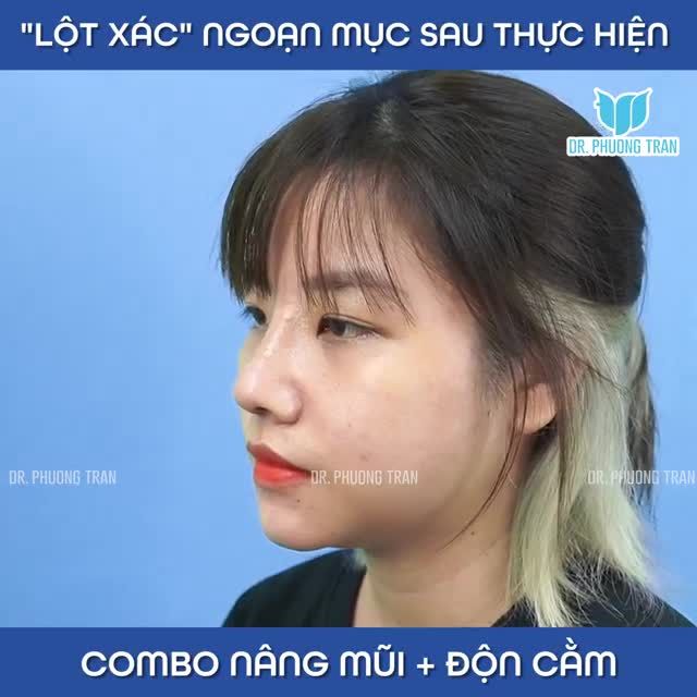 "LỘT XÁC" NGOẠN MỤC VỚI COMBO NÂNG MŨI CẤU TRÚC ĐỘN CẰM