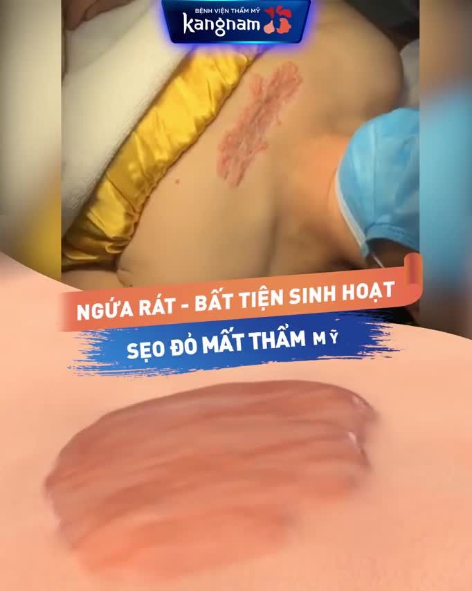 SẸO LỒI VÙNG XƯƠNG ỨC Làm sao LÀ PHẲNG hoàn toàn?
