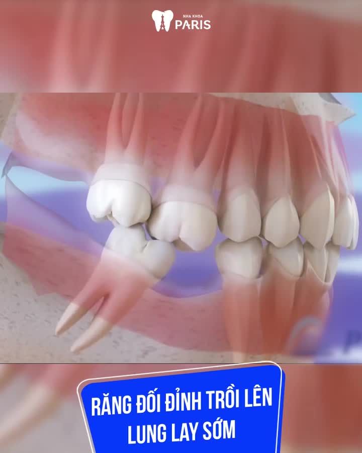 Tiêu Xương/ Hóp Má/Lão Hóa Sớm???