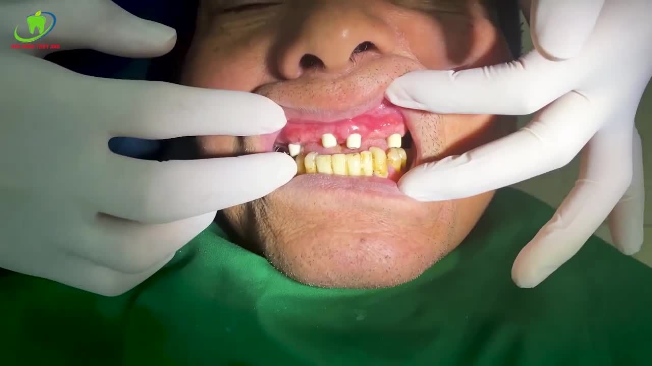 ĂN NHAI CHẮC KHOẺ RỘN RÀNG ĐÓN TẾT VỚI IMPLANT ALL ON 4