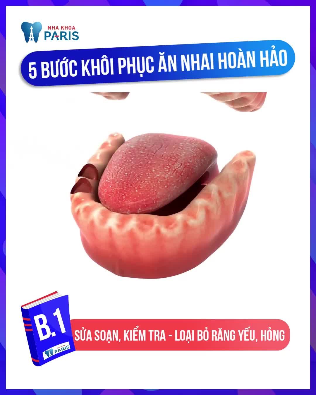 GIẢI PHÁP KHÔI PHỤC MẤT RĂNG TOÀN HÀM