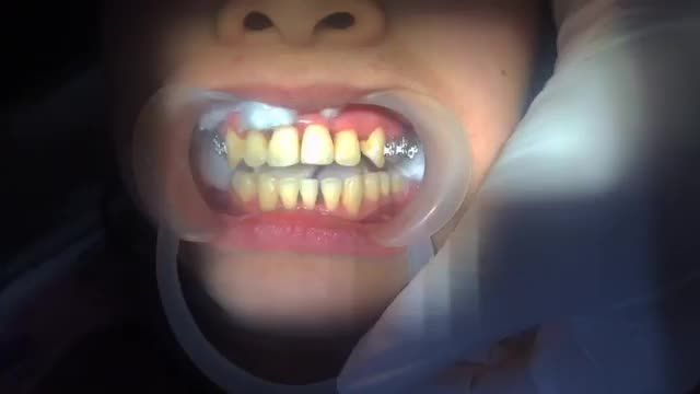 Gắn mắc cài cho khách hàng răng HÔ 2 hàm