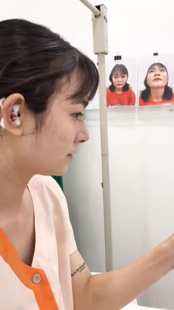 Khách hàng nâng mũi cấu trúc sụn tai surgiform