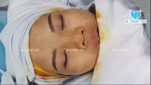 NÂNG MŨI CẤU TRÚC SỤN SƯỜN TOÀN PHẦN MŨI ĐẸP AN TOÀN, NÓI KHÔNG VỚI BIẾN CHỨNG VÀ ĐÀO THẢI CHẤT LIỆU
