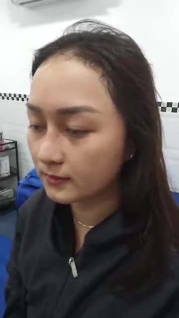 TÁI KHÁM NÂNG MŨI CAO TÂY CUỘN CÁNH MŨI SAU 10 NGÀY BẠN GÁI XINH NHƯ HOTGIRL