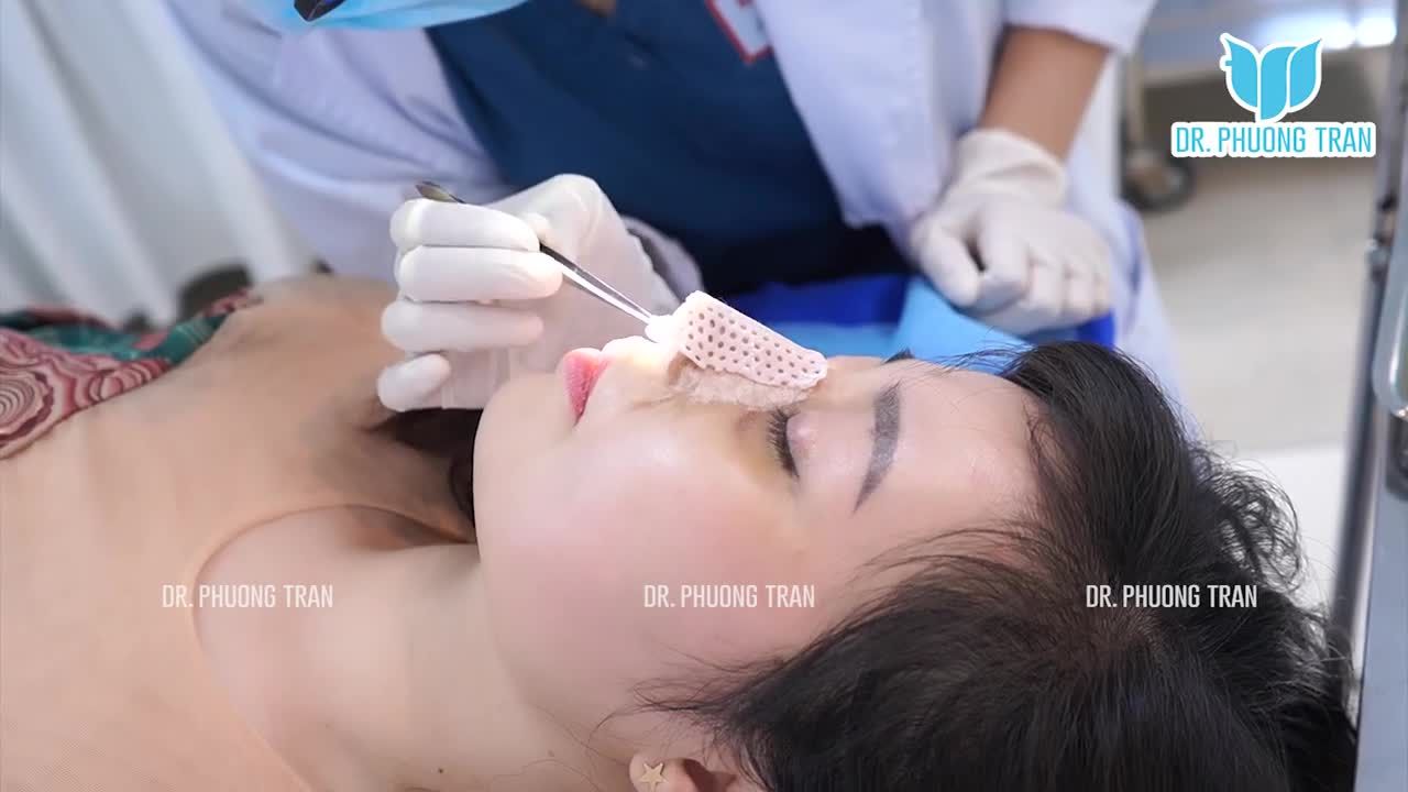 THÁO NẸP KHI MỚI CHỈ 5 NGÀY SAU PHẪU THUẬT, CHIẾC MŨI SẼ THẾ NÀO?