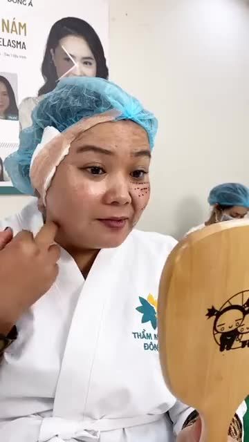 Kết quả làm 1/2 gương mặt sau căng chỉ Bio Lift