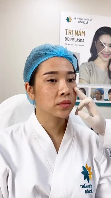 Phân tích tình trạng da trước cấy BIO COLLAGEN