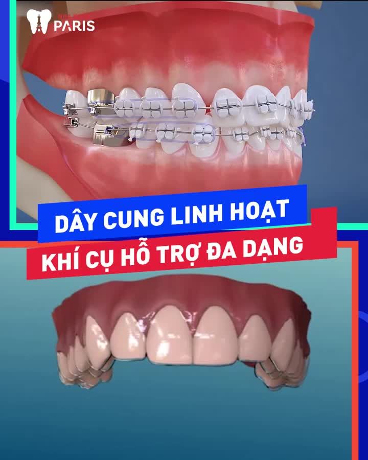 Những đặc quyền chỉ riêng Niềng răng tại Paris mới có