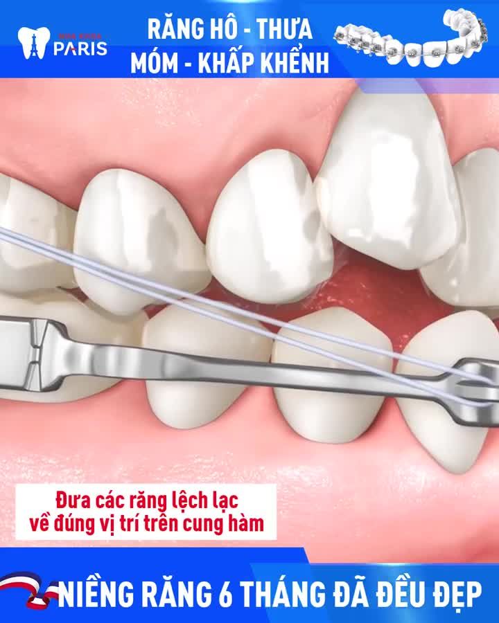 RĂNG KHẤP KHỂNH, THƯA, HÔ, MÓM, MỌC LỆCH