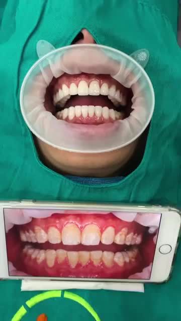 Ca gắn răng sứ cuối ngày tại nha khoa VIET SMILE