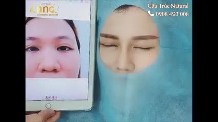CẬN CẢNH DÁNG MŨI CẤU TRÚC NATURAL SAU KHI NÂNG