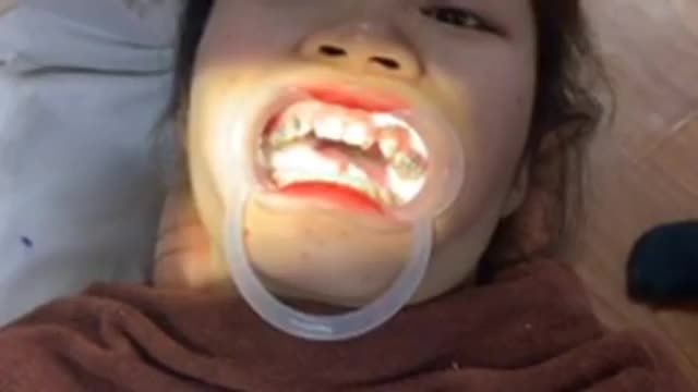 Gắn mắc cài cho khách hàng răng KHẤP KHỂNH