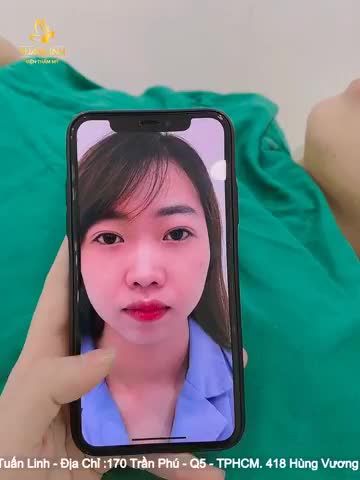 KHÁCH HÀNG NÂNG MŨI CẤU TRÚC