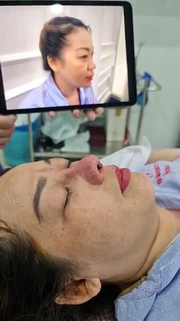 NÂNG MŨI CẤU TRÚC NANOFORM