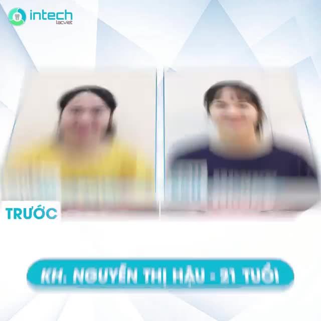 NIỀNG RĂNG GIẢI PHÁP GIÚP "ĐẬP TAN" MỌI KHUYẾT ĐIỂM CỦA NỤ CƯỜI