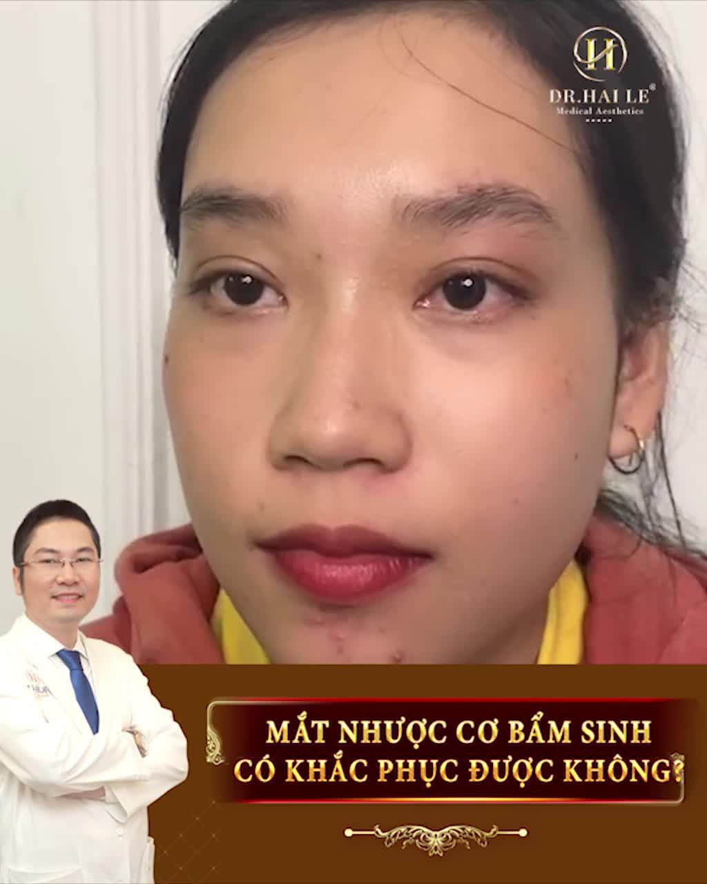 MẮT SIÊU KHÓ. Mắt bị nhược cơ bẩm sinh, 2 mí không đều stress lắm, tự ti vô cùng.