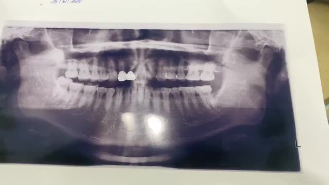 Cấy chân răng nhân tạo implant cho khách hàng