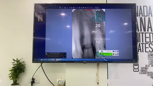 Cấy chân răng ipl R12 do khách hàng không may bị gãy.