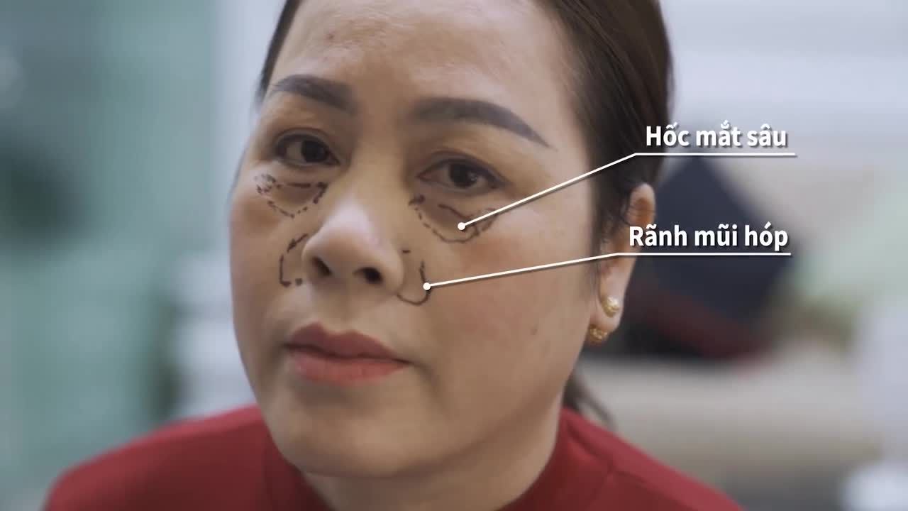 CẤY MỠ BIO NANO  Đẹp bền vững theo thời gian