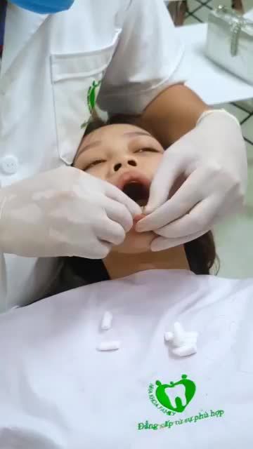 GẮN VENEER SỨ CHO KHÁCH HÀNG MAI PHƯƠNG