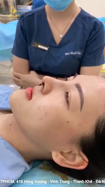 Nâng mũi cấu trúc Surgiform sau 1h30p Dáng mũi AngelLine