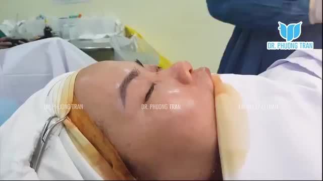 NÂNG MŨI SỤN SƯỜN: GIẢI PHÁP TỐI ƯU CHO CHIẾC MŨI ĐẸP TỰ NHIÊN AN TOÀN BỀN VỮNG NHẤT HIỆN NAY