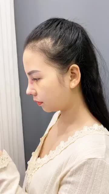 TÁI KHÁM SAU 5 NGÀY MŨI SỤN SURGIFORM TẠI BÁC SĨ KHẢI!