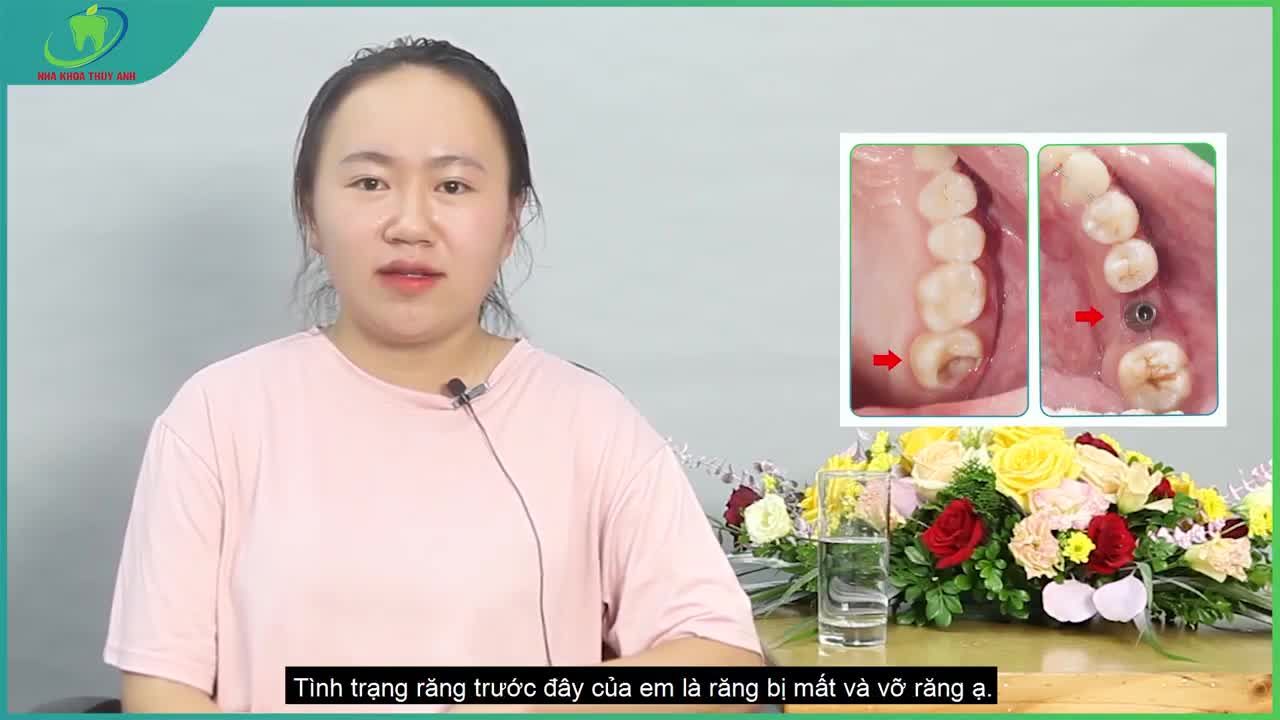 TRỒNG RĂNG IMPLANT KẾT HỢP PHỤC HÌNH RĂNG SÂU VỠ LỚN BẰNG MIỀNG DÁN INLAY, ONLAY SỨ