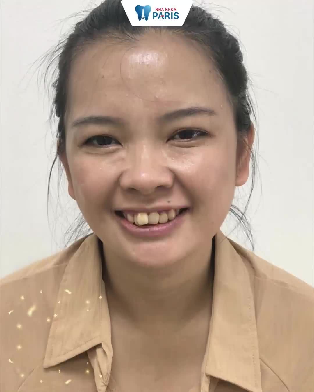 Bọc Răng Sứ Sale Hết Mình Đẹp Hết Hồn