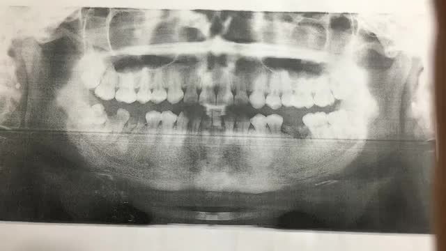 Ca cấy chân răng implant tại vị trí 36 sau kho đã nhổ chân răng sâu vỡ.