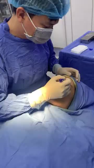 Quy trình đo vẽ cấy mỡ mặt Bio Gen tại BVTM Đông Á
