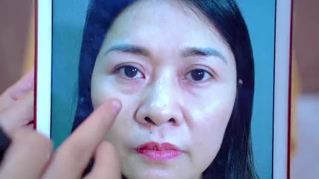 GIẢI CỨU CA MÍ LỖI HỎNG DO THỰC HIỆN TẠI CƠ SỞ KHÔNG UY TÍN GIÚP VỊ KHÁCH HÀNG TỰ TIN SỞ HỮU ĐÔI MẮT LÀNH LẶN CHUẨN BỊ ĐÓN NĂM MỚI 2021