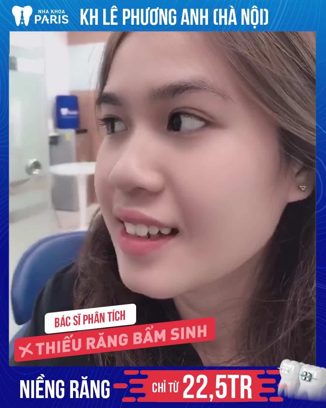Răng Hô, Khấp Khểnh, Thiếu Răng Bẩm Sinh