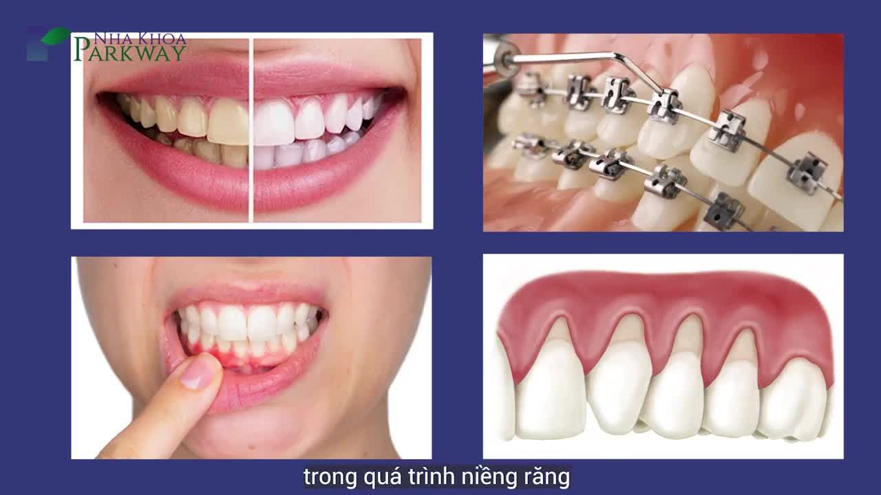 BẠN ĐÃ VỆ SINH RĂNG MIỆNG ĐÚNG CÁCH KHI NIỀNG?