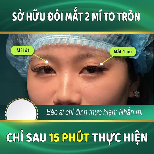 Bạn đang muốn khắc phục đôi mắt 1 mí, mí lót...